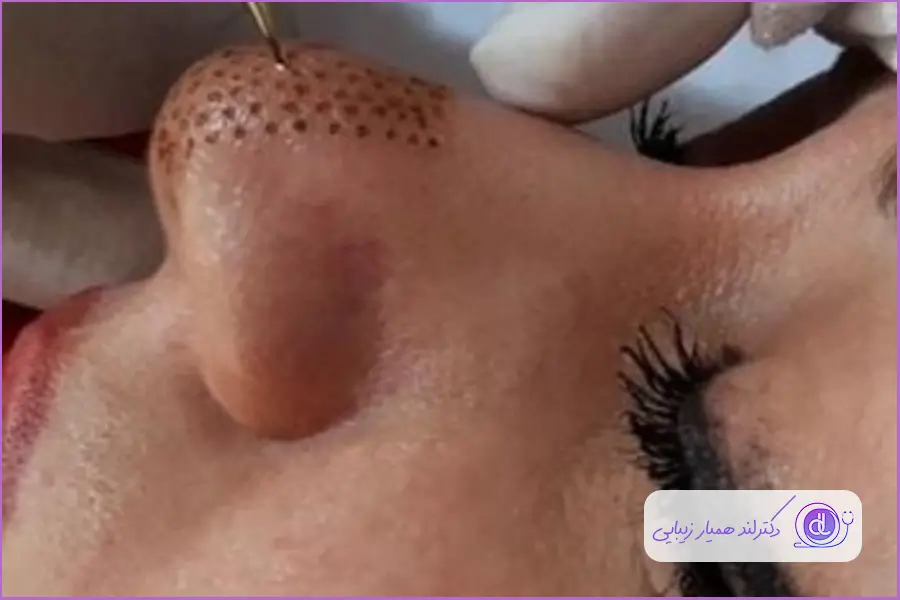 کوچک کردن بینی گوشتی | راهکارهای غیرجراحی و ایمن مزایای پلاسما جت برای کوچک کردن بینی گوشتی