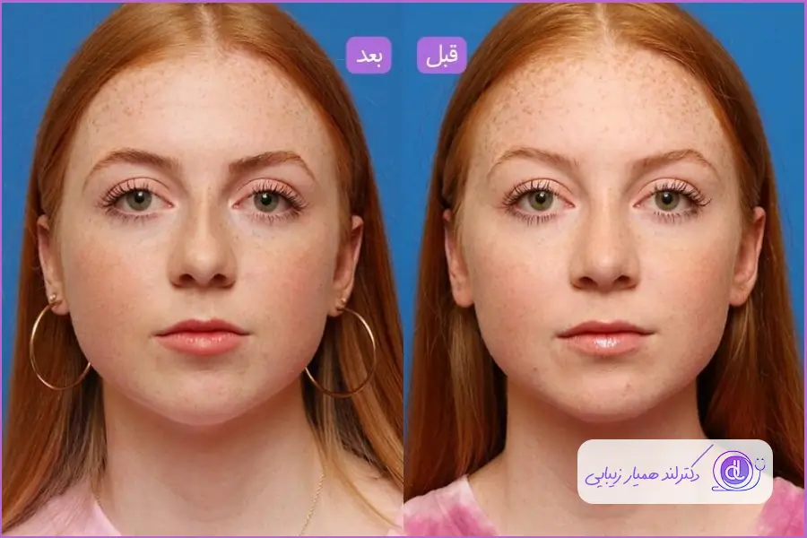 عمل بینی با پوست ضخیم | تاثیر پوست ضخیم در جراحی بینی روند بهبودی ورم بعد از عمل جراحی بینی گوشتی با پوست زخیم طولانی تر است