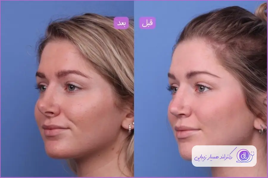 کوچک کردن بینی گوشتی | راهکارهای غیرجراحی و ایمن قبل و بعد فرم دهی بینی گوشتی با سوهان کشی