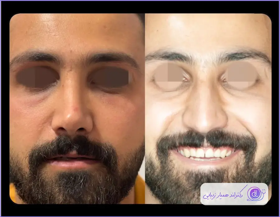 عمل بینی مردانه | بهترین مدلها و روشهای جراحی بینی برای آقایان نمونه قبل و بعد عمل جراحی طبیعی بینی گوشتی مردانه دکتر آرش سبحان منش