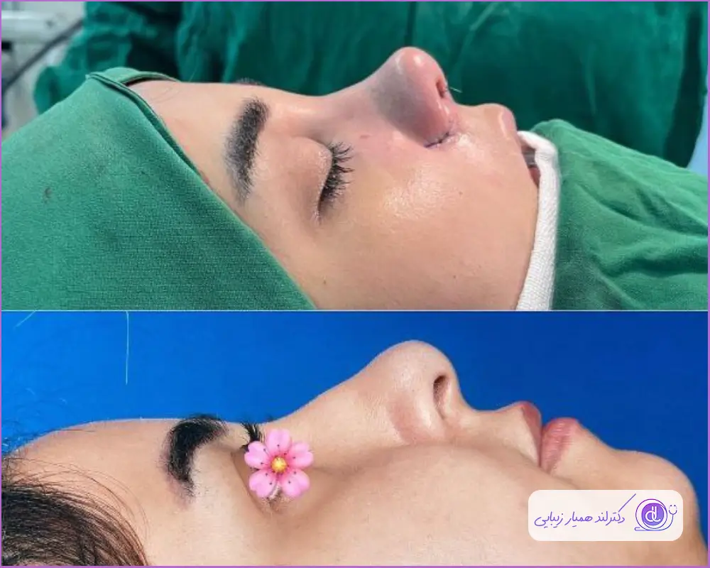 عمل بینی فانتزی عروسکی | بررسی صفر تا 100 جراحی بینی فانتزی عروسکی تبدیل دماغ گوشتی به فانتزی دخترانه دکتر آرش طهماسبی