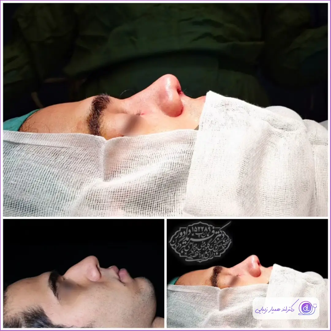 عمل بینی مردانه | بهترین مدلها و روشهای جراحی بینی برای آقایان نمونه رینوپلاستی دماغ گوشتی مردانه دکتر فرید دادور