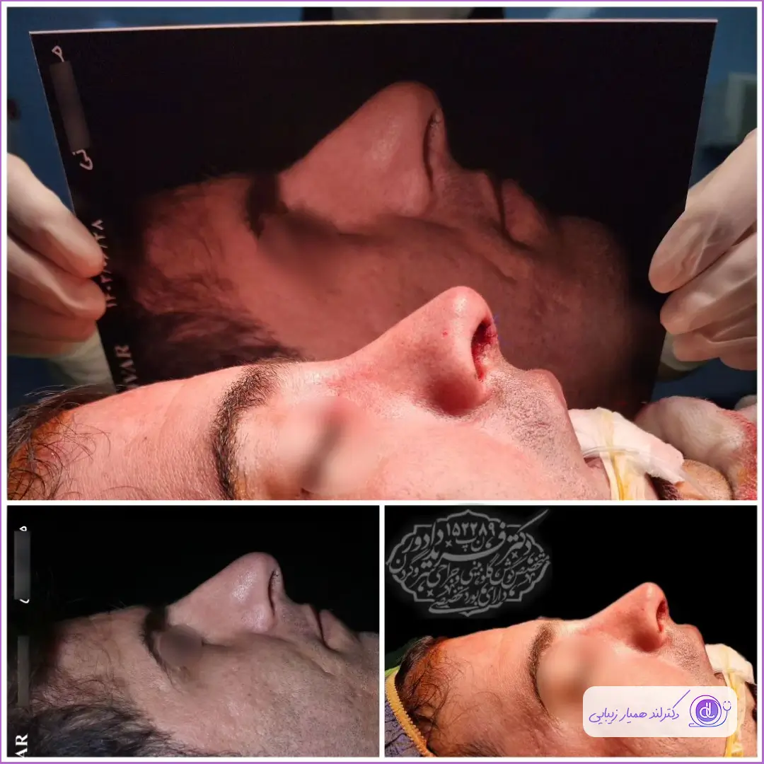 عمل بینی مردانه | بهترین مدلها و روشهای جراحی بینی برای آقایان کوچک کردن بینی گوشتی مردانه دکتر فرید دادور
