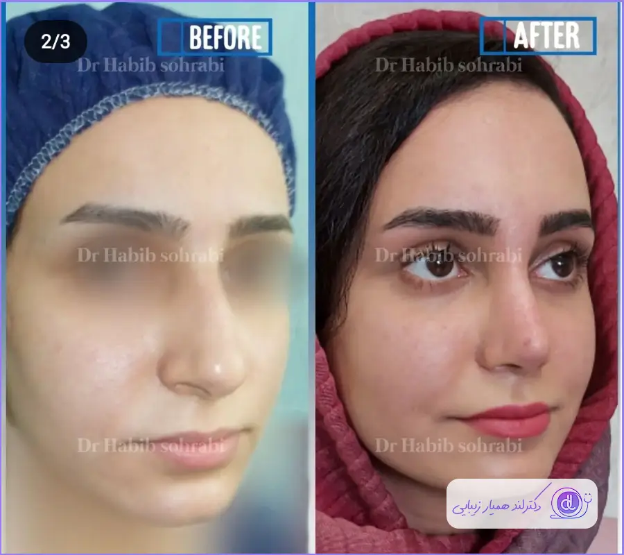 انواع عمل بینی | بهترین مدل های بینی برای عمل 1403 نمونه کار قبل و بعد عمل طبیعی دماغ گوشتی
