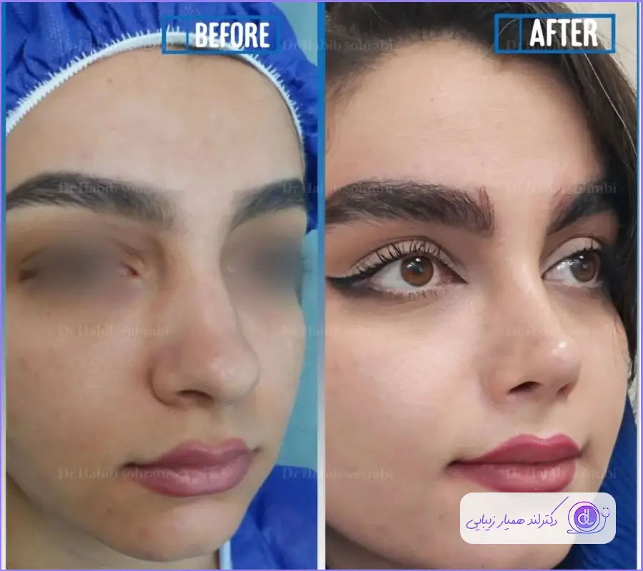 عمل بینی با پوست ضخیم | تاثیر پوست ضخیم در جراحی بینی عمل بینی با پوست ضخیم