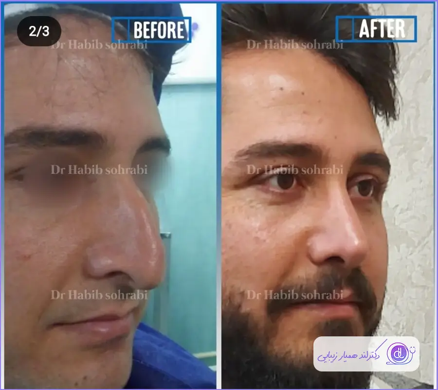 عمل بینی قوزدار | روشهای جراحی و لیست بهترین جراحان بینی قوزدار جراحی بینی مردانه قوز دار