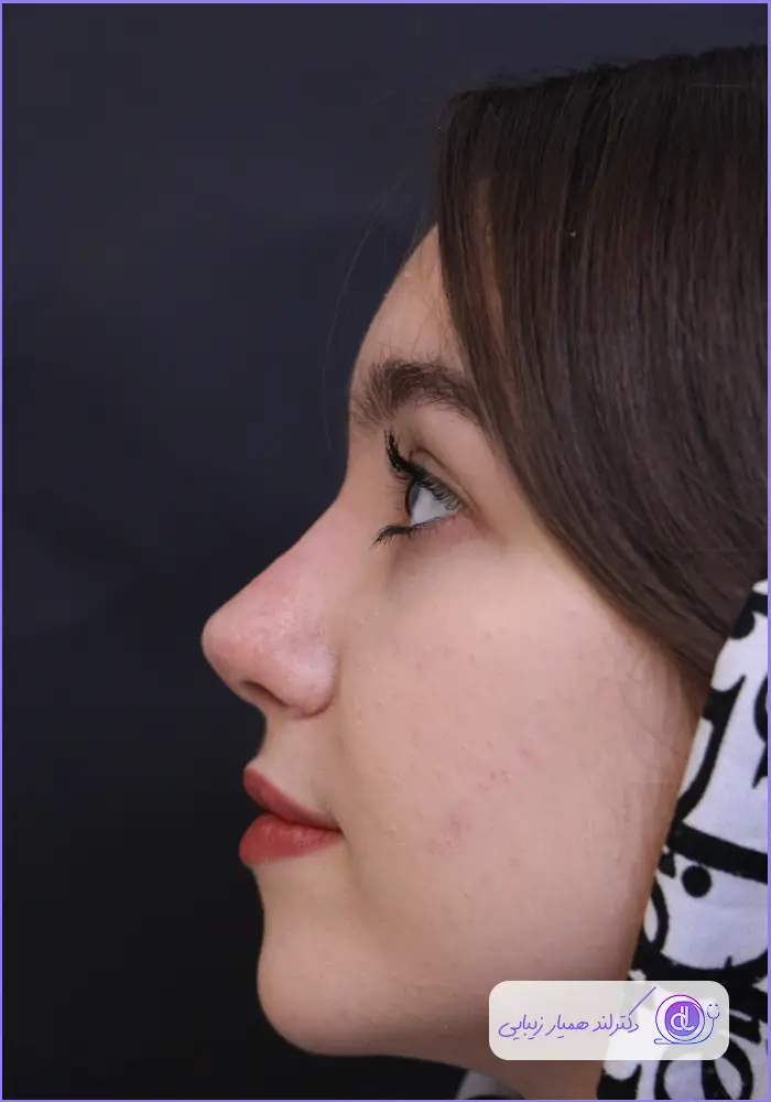 نمونه قبل و بعد عمل زیبایی دماغ به سبک طبیعی دکتر حمید نوری