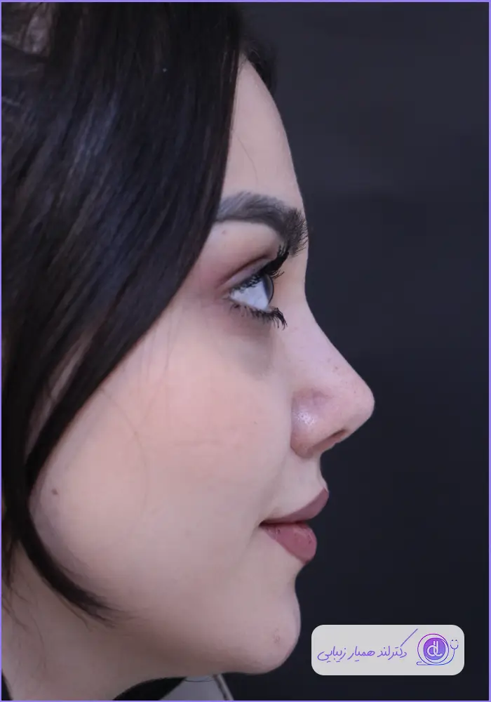 عمل بینی نیمه فانتزی؛ از 0 تا 100 جراحی بینی نیمه فانتزی عمل بینی نیمه فانتزی-4