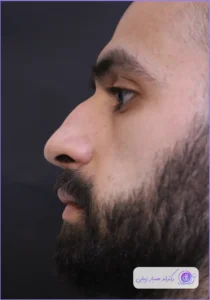 عمل بینی استخوانی؛ مدلهای پرطرفدار و نکات طلایی جراحی عمل بینی استخوانی-2