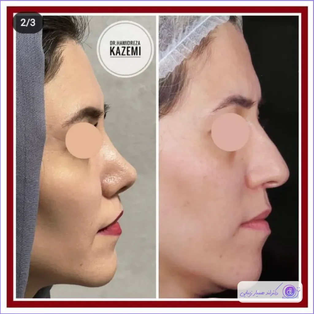 عمل بینی نیمه فانتزی؛ از 0 تا 100 جراحی بینی نیمه فانتزی عمل بینی نیمه فانتزی؛ از 0 تا 100 جراحی بینی نیمه فانتزی