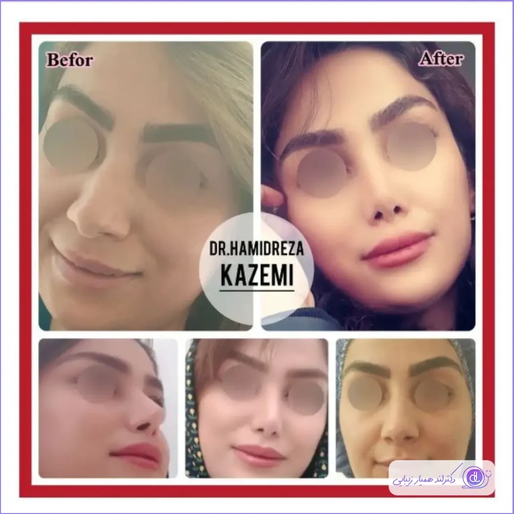 انواع عمل بینی | بهترین مدل های بینی برای عمل 1403 نمونه کار رینوپلاستی به سبک نیمه فانتزی