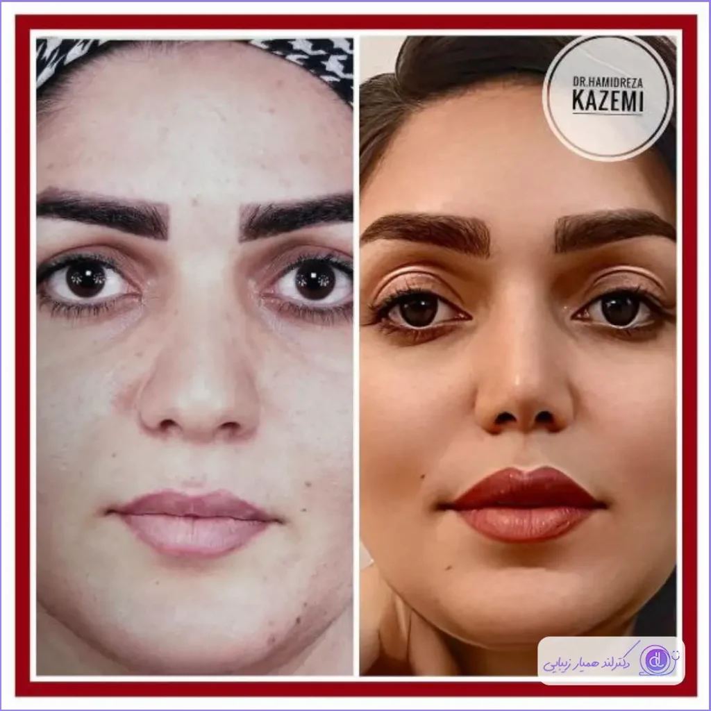 عمل بینی نیمه فانتزی؛ از 0 تا 100 جراحی بینی نیمه فانتزی عمل بینی نیمه فانتزی؛ از 0 تا 100 جراحی بینی نیمه فانتزی