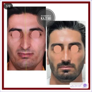 عمل بینی استخوانی؛ مدلهای پرطرفدار و نکات طلایی جراحی عمل بینی استخوانی-3