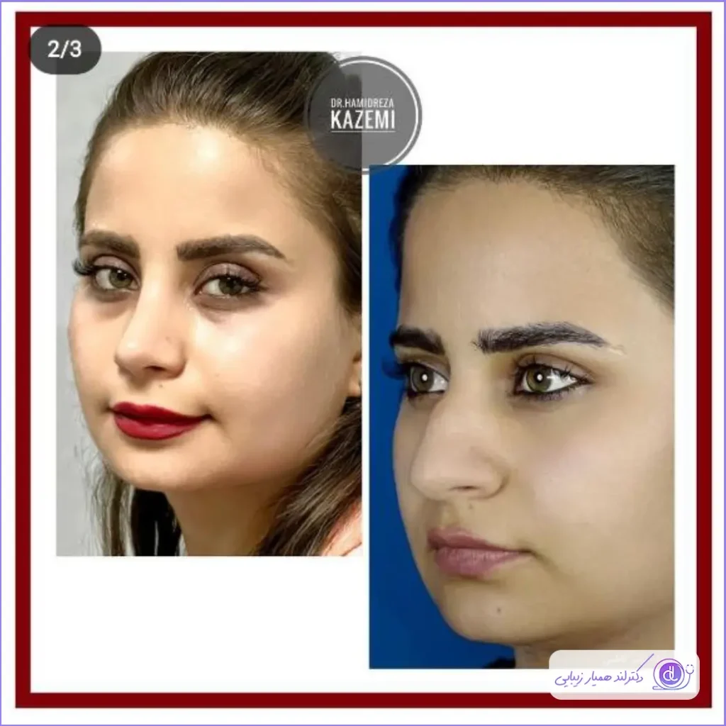 عمل بینی نیمه فانتزی؛ از 0 تا 100 جراحی بینی نیمه فانتزی عمل بینی نیمه فانتزی؛ از 0 تا 100 جراحی بینی نیمه فانتزی