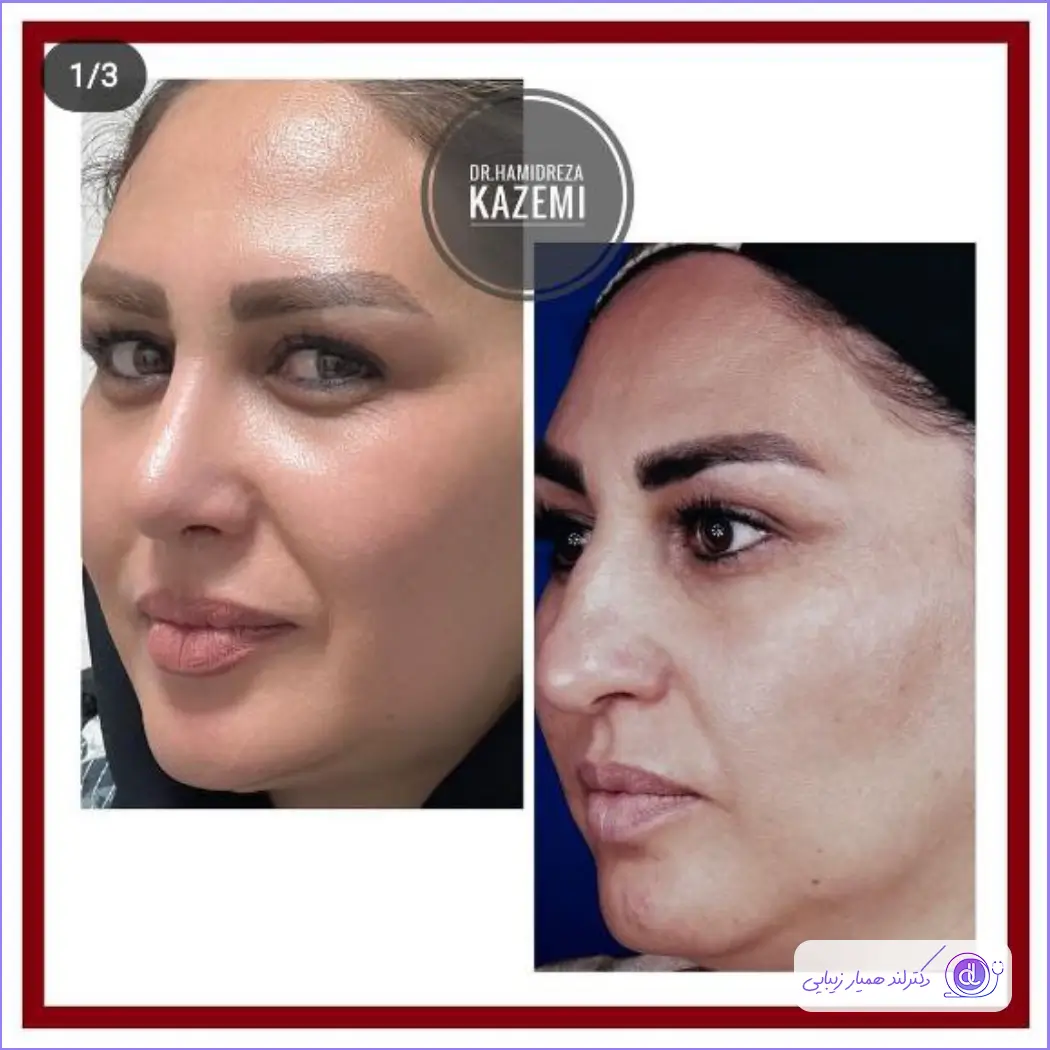 عمل بینی قوزدار | روشهای جراحی و لیست بهترین جراحان بینی قوزدار نمونه جراحی زیبایی بینی قوز دار