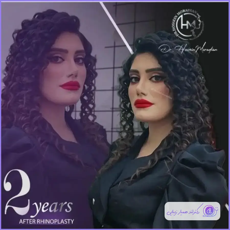 عمل بینی فانتزی عروسکی | بررسی صفر تا 100 جراحی بینی فانتزی عروسکی جراحی دماغ سبک فانتزی دکتر حسین مرادیان