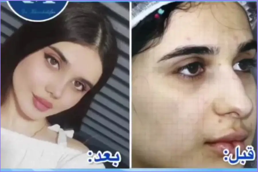 عمل بینی قوزدار | روشهای جراحی و لیست بهترین جراحان بینی قوزدار قبل و بعد جراحی بینی قوز دار دکتر عبدالرضا خورشیدی فر