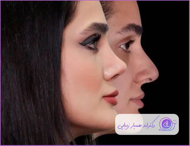 عمل بینی فانتزی عروسکی | بررسی صفر تا 100 جراحی بینی فانتزی عروسکی قبل و بعد جراحی بینی گوشتی مدل فانتزی زنانه دکتر محمد طالب زاده