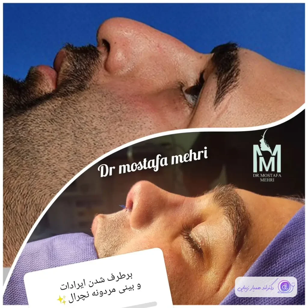 تبدیل دماغ غضروفی مردانه سبک نیمه فانتزی دکتر مصطفی مهری