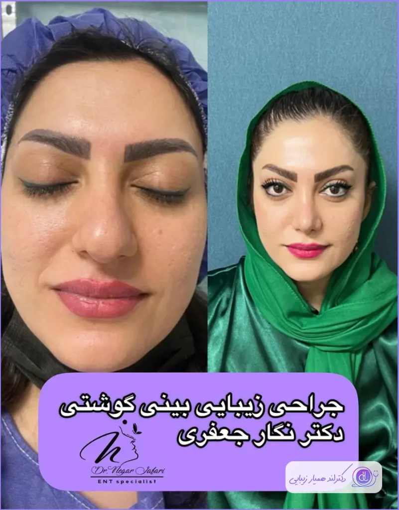 عمل بینی پهن + هزینه جراحی بینی پهن گوشتی جراحی دماغ گوشتی به سبک طبیعی دکتر نگار جعفری