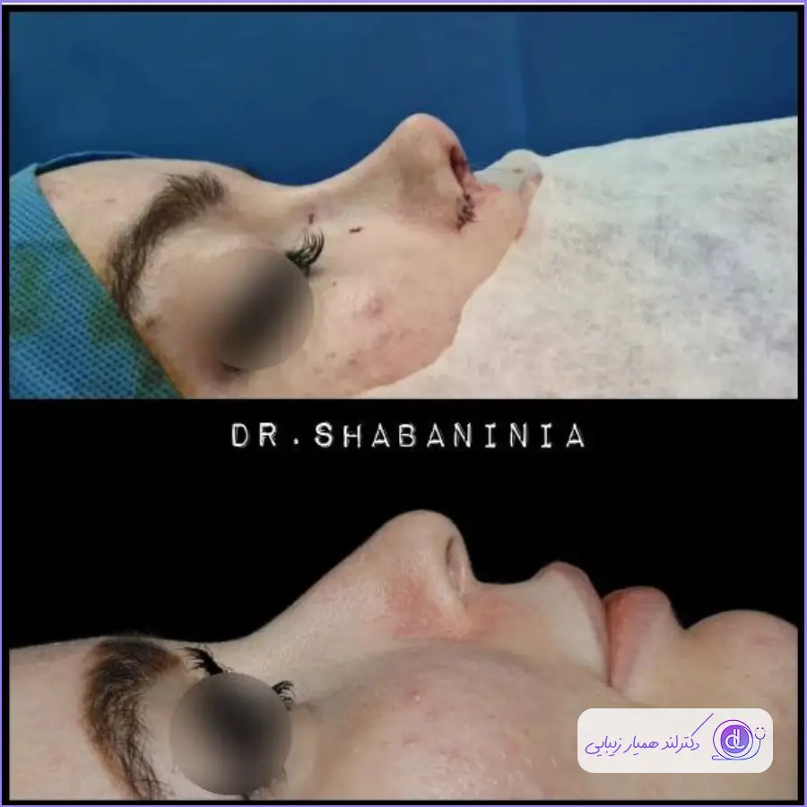 عمل بینی فانتزی عروسکی | بررسی صفر تا 100 جراحی بینی فانتزی عروسکی نمونه کار قبل و بعد عمل دماغ به سبک نیمه فانتزی دکتر شعبانی نیا