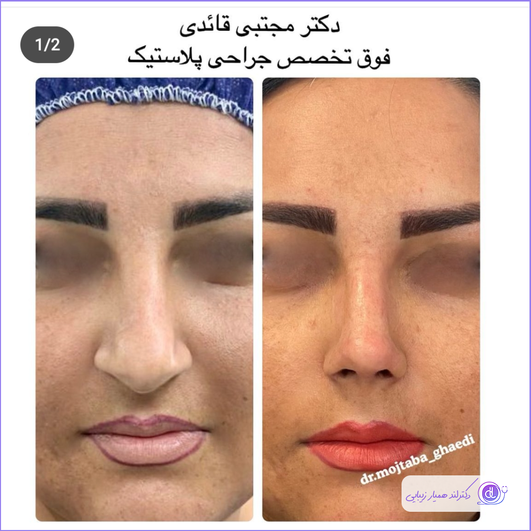 عمل بینی زنانه و دخترانه | بهترین روشها و معرفی جراحان برتر جراحی دماغ گوشتی زنانه