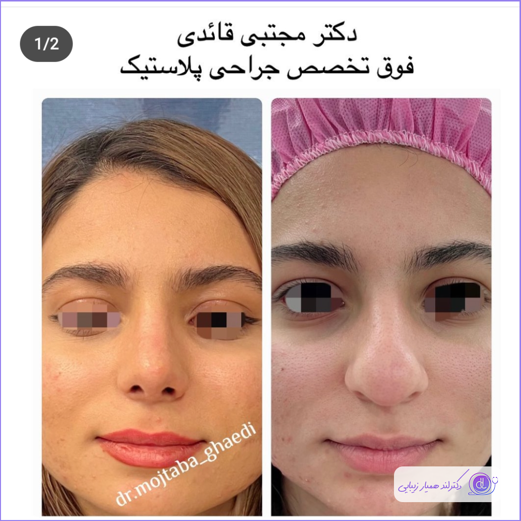 عمل بینی پهن + هزینه جراحی بینی پهن گوشتی نمونه کار رینوپلاستی بینی گوشتی به سبک نیمه فانتزی دکتر مجتبی قائدی