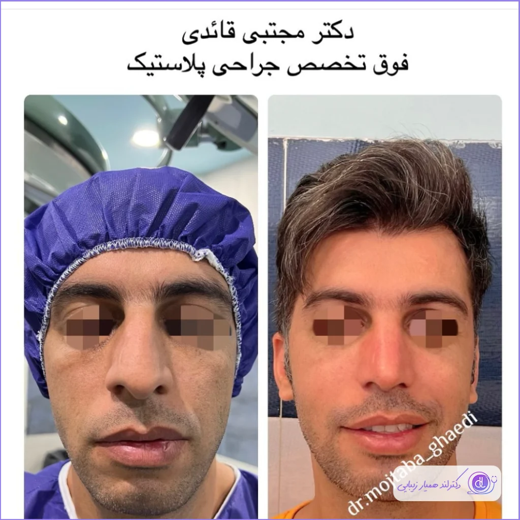 عمل بینی پهن + هزینه جراحی بینی پهن گوشتی نمونه جراحی بینی مردانه دکتر مجتبی قائدی