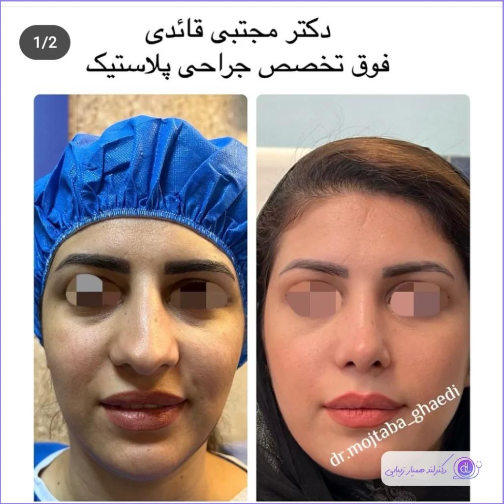 عمل بینی پهن + هزینه جراحی بینی پهن گوشتی نمونه کار عمل زیبایی دماغ گوشتی دکتر مجتبی قائدی