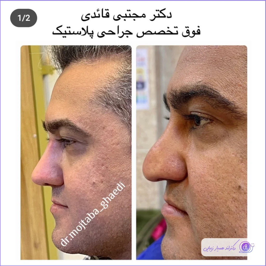 قبل و بعد عمل دماغ گوشتی مردانه سبک طبیعی دکتر مجتبی قائدی