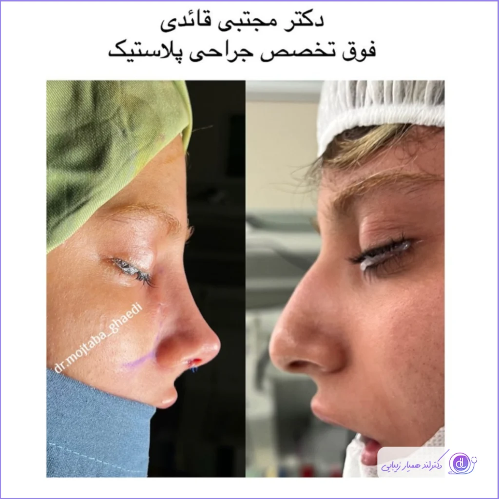 نمونه قبل و بعد جراحی دماغ غضروفی سبک نیمه فانتزی دکتر مجتبی قائدی