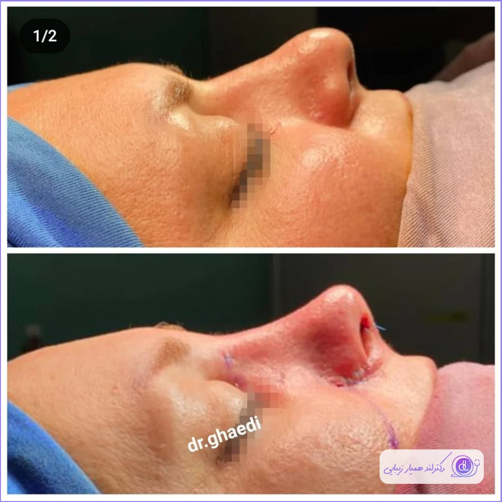 عمل بینی نیمه فانتزی؛ از 0 تا 100 جراحی بینی نیمه فانتزی عمل بینی نیمه فانتزی-5