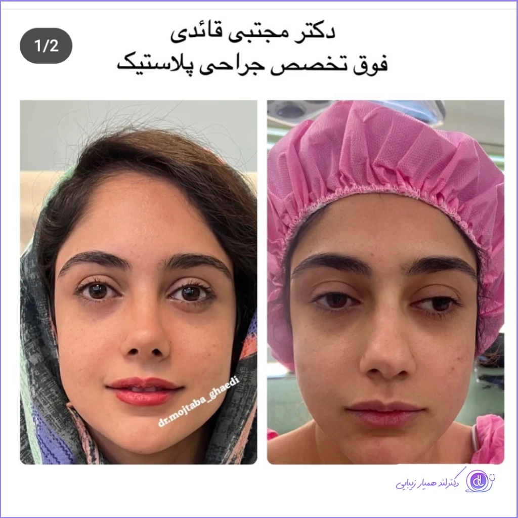 عمل بینی فانتزی عروسکی | بررسی صفر تا 100 جراحی بینی فانتزی عروسکی تبدیل بینی گوشتی به نیمه فانتزی دکتر مجتبی قائدی