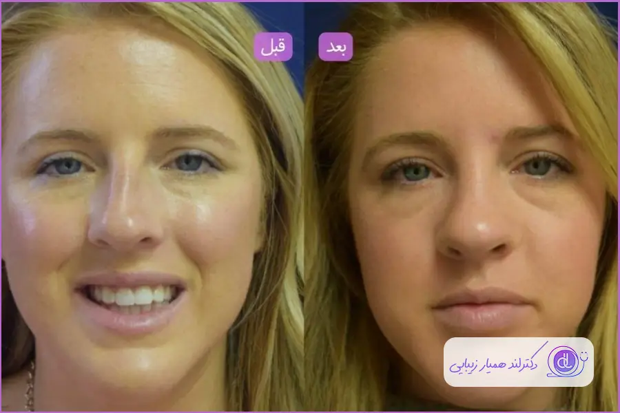 عمل بینی با پوست ضخیم | تاثیر پوست ضخیم در جراحی بینی عمل ثانویه به دلیل انتخاب جراح نامناسب