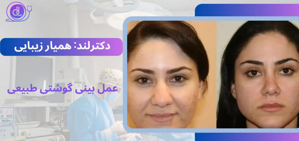 عمل بینی طبیعی از ۰ تا ۱۰۰ | معرفی بهترین جراحان بینی طبیعی عمل بینی طبیعی-6