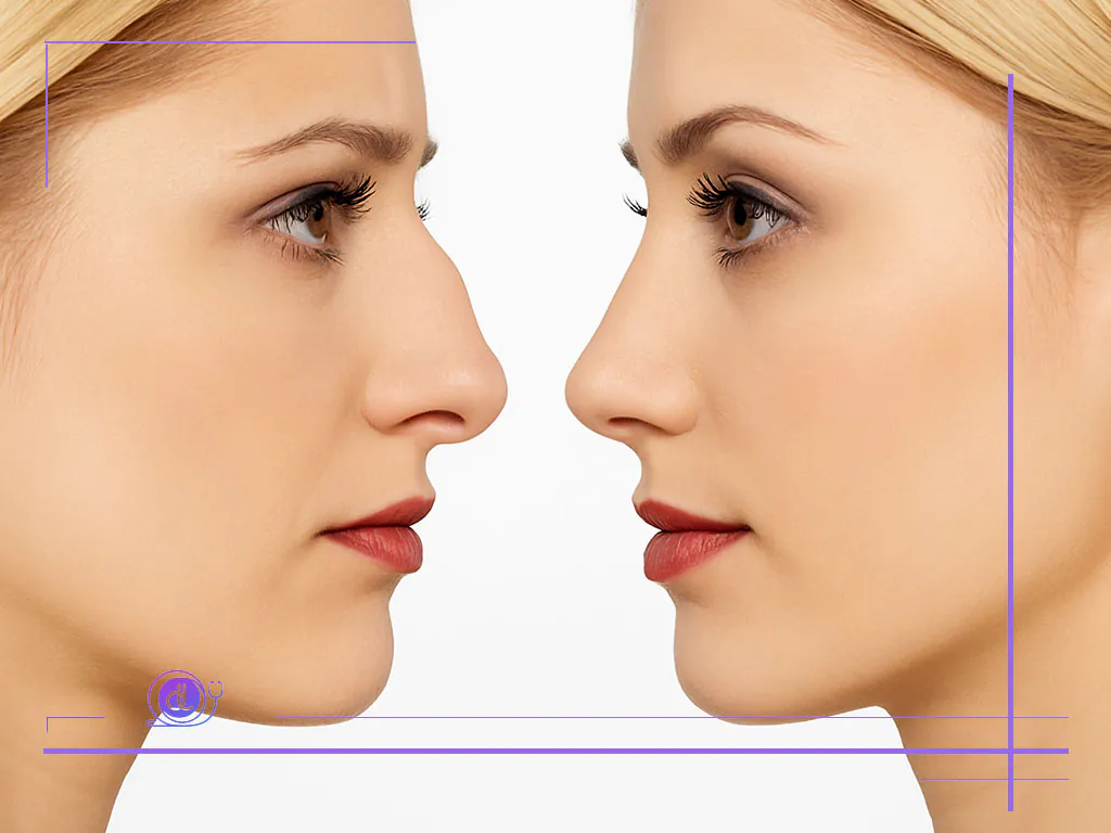 عمل بینی هایپر نچرال | قیمت جراحی طبیعی بینی و تفاوت سبک ها عمل بینی هایپر نچرال-2