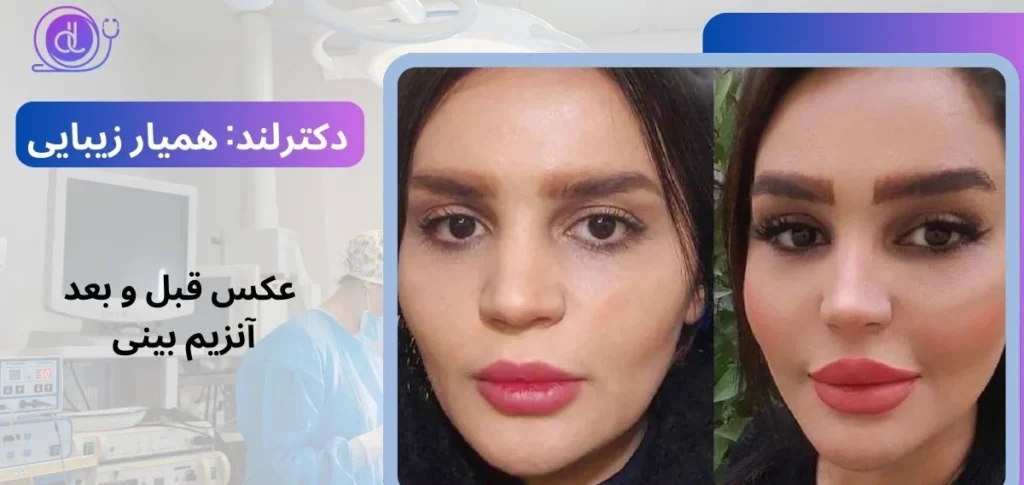 آنزیم بینی | آنزیم بینی گوشتی آسان ترین راه کوچک کردن بینی آنزیم بینی | آنزیم بینی گوشتی آسان ترین راه کوچک کردن بینی