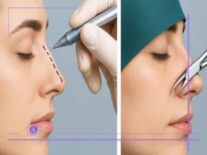 مراحل انجام عمل بینی