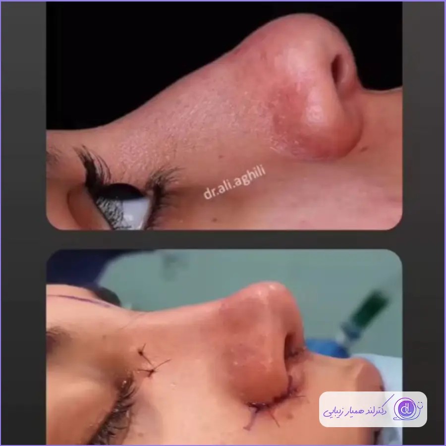 بهترین جراح بینی گوشتی در اصفهان-دکتر علی عقیلی