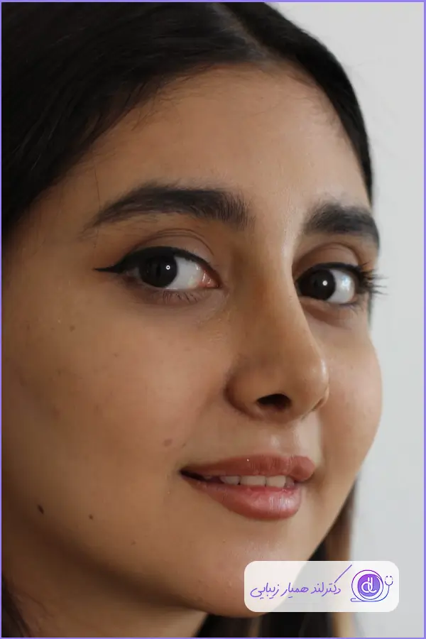 بهترین جراح بینی طبیعی در تهران | معرفی 5 پزشک برتر + هزینه و نمونهکار بهترین جراح بینی طبیعی در تهران-11