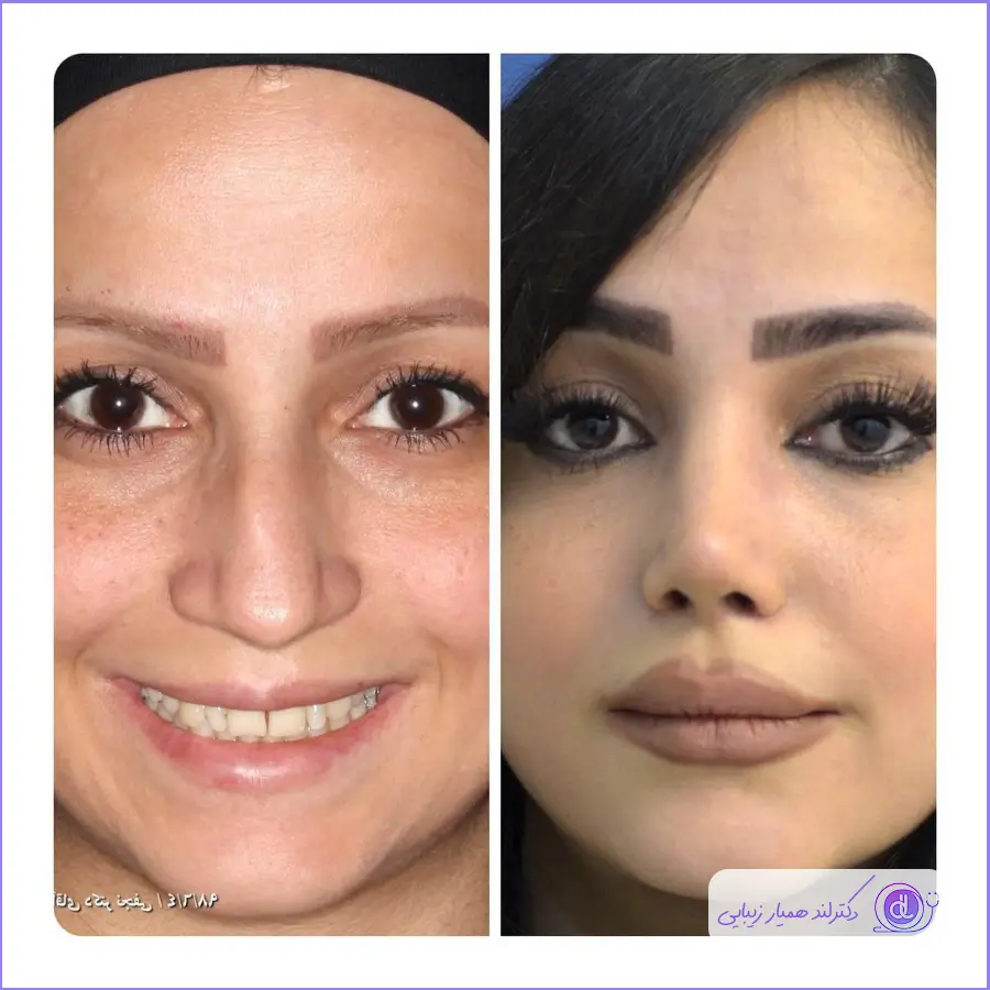 بهترین جراح بینی طبیعی در تهران | معرفی 5 پزشک برتر + هزینه و نمونهکار بهترین جراح بینی طبیعی در تهران-12