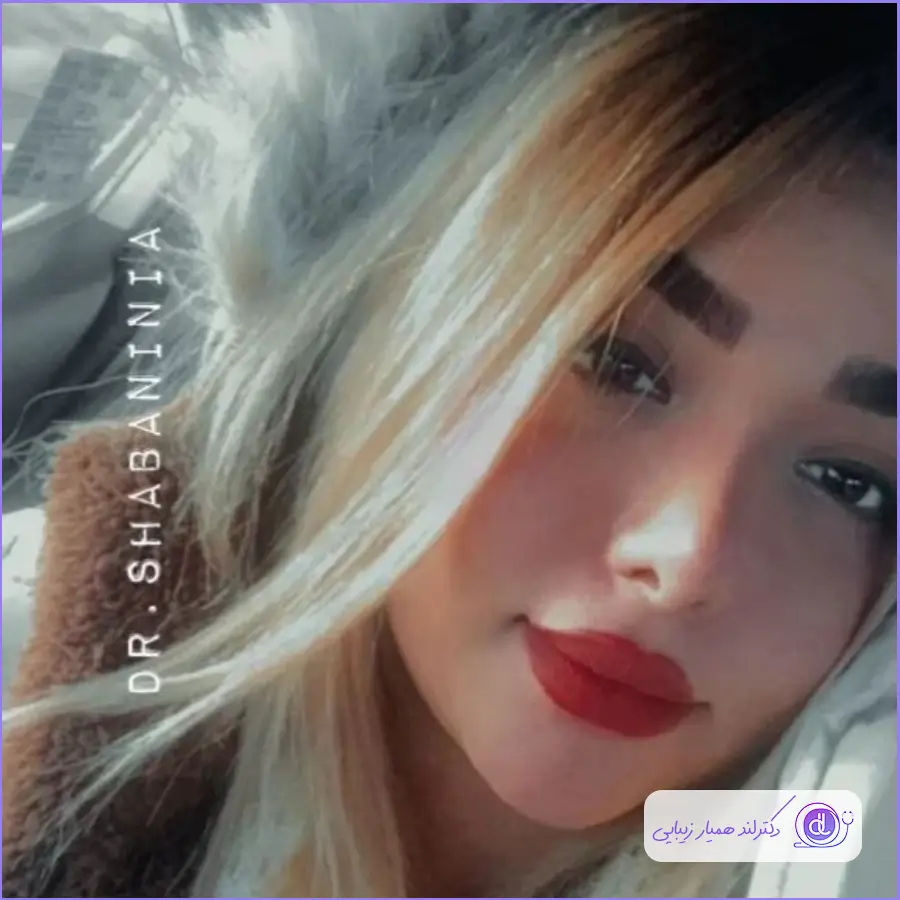 بهترین جراح بینی طبیعی در تهران | معرفی 5 پزشک برتر + هزینه و نمونهکار نمونه کارهای دکتر شهریار شعبانی نیا-3