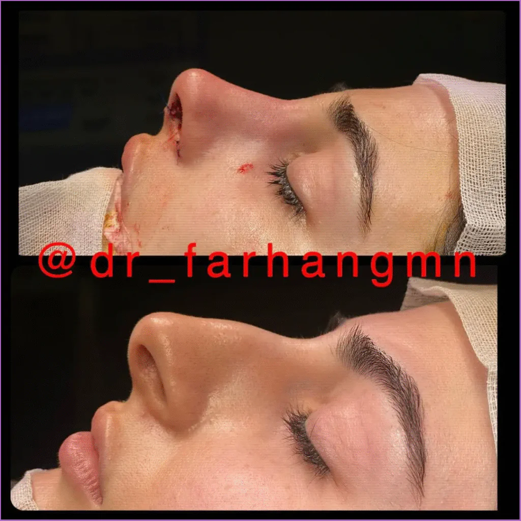 بهترین جراح بینی در اصفهان ۱۴۰۴ + لیست ۱۰ پزشک برتر بهترین جراح بینی در اصفهان-نمونه عمل دکتر فرهنگ مختاری نژاد-3