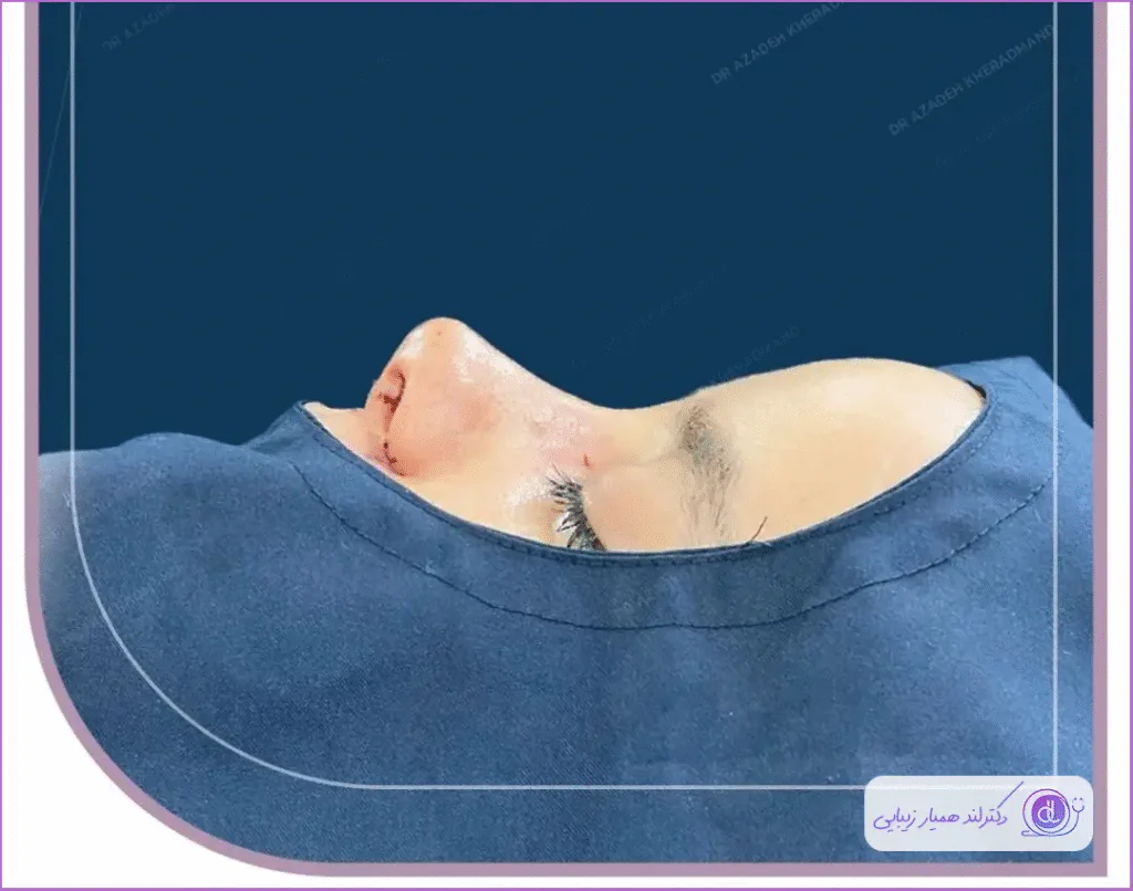 بهترین جراح بینی گوشتی در اصفهان ۱۴۰۴ | معرفی متخصصان برتر و هزینه عمل بهترین جراح بینی گوشتی در اصفهان-دکتر آزاده خردمند-9