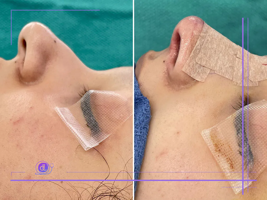 جراحی بینی با لیزر در تهران | روش نوین زیبایی بدون تیغ جراحی با دکترلند جراحی بینی با لیزر در تهران-1