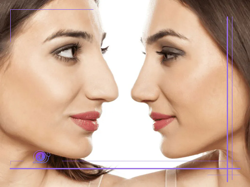 جراحی بینی با لیزر در تهران | روش نوین زیبایی بدون تیغ جراحی با دکترلند جراحی بینی با لیزر در تهران-هزینه