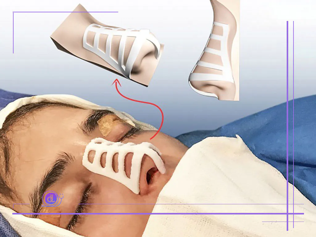 جراحی بینی با قالب کنترلی در اصفهان؛ دقت میلیمتری در فرمدهی بینی جراحی بینی با قالب کنترلی در اصفهان