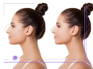 سوهان کشی بینی