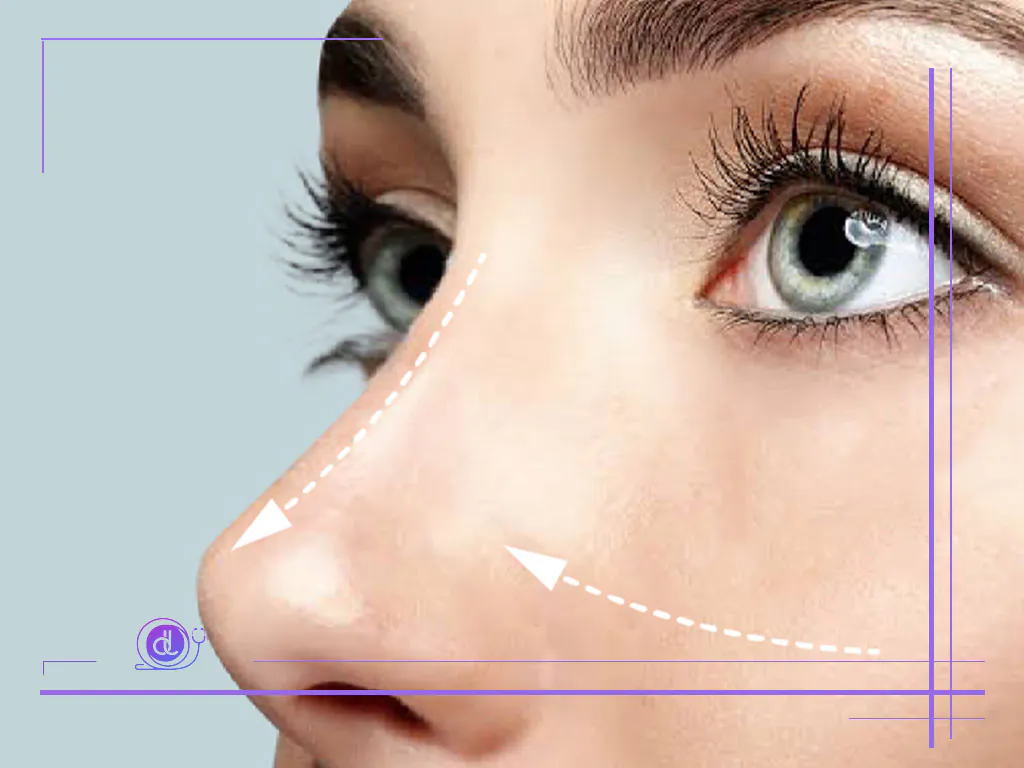 سوهان کشی بینی بعد از عمل بینی در شیراز | رفع قوز و ناهمواری با کمترین درد و نقاهت سوهان کشی بینی بعد از عمل بینی در شیراز-4