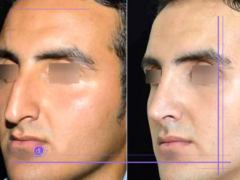 جراحی بینی با قالب کنترلی در اصفهان؛ دقت میلیمتری در فرمدهی بینی جراحی بینی با قالب کنترلی در اصفهان-2